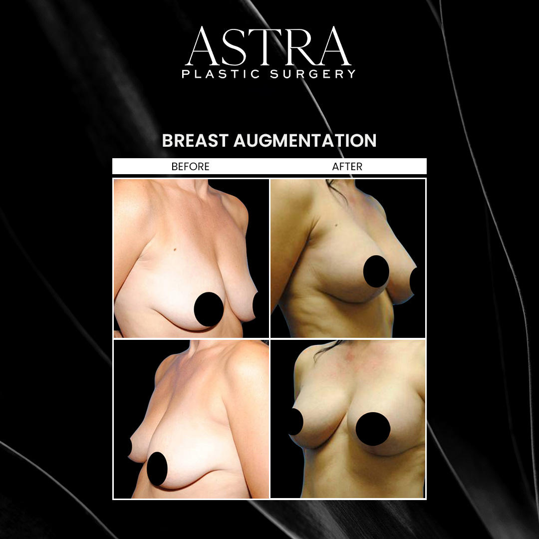 Breast enhancement procedures can lift and reshape the breasts and add or decrease volume. Breast enhancement surgery such as breast augmentation and breast lift can improve the size and positioning of the breasts for youthful, fuller-looking results. Patients wishing to reduce the contours of the breasts may choose to undergo breast reduction or areola reduction. Our Atlanta plastic surgeons also specialize in breast reconstruction surgery, offering the most compassionate care following breast cancer and mastectomy.