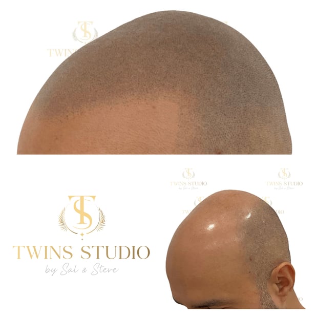 Images Twins Studio (Scalp Micropigmentation - SMP)