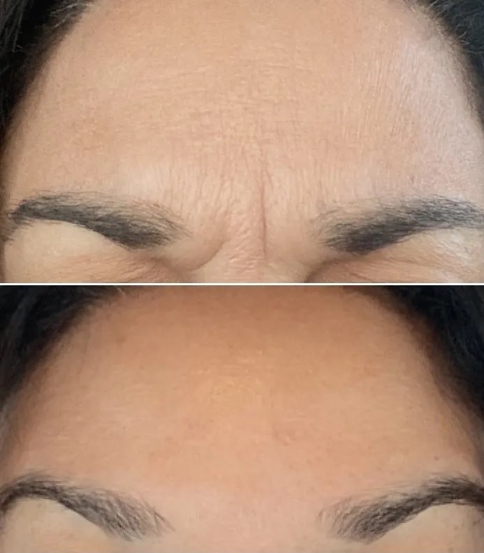 Botox, Frown Lines Before & 3 weeks After Botox