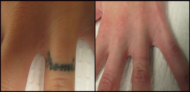 rethink the ink tattoo removal las vegas las vegas nevada rethink the ink tattoo removal las vegas las vegas nevada