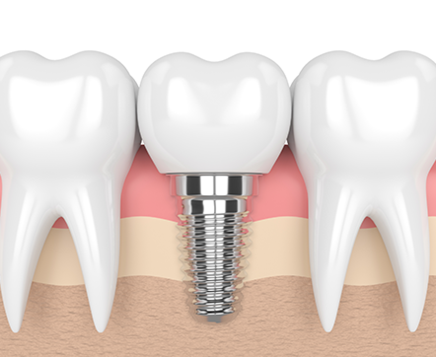 Images Centre de Spécialistes Dentaires Zeeba - Parodontie, Endodontie, Implant dentaire Longueuil