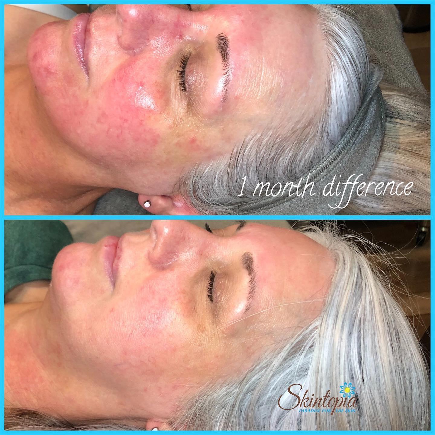 Rosacea treatment at Skintopia in Scottsdale