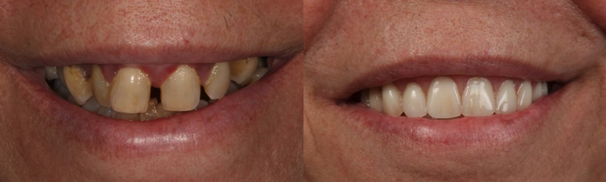 Dentures Before & After at Schmitt Prosthodontics | Altamonte Springs, FL