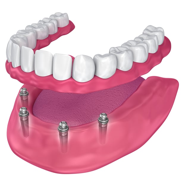 Images Best Value Dentures and Implants Palmetto Bay