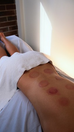 Cupping Massage with Winter Park Chiropractic & Acupuncture