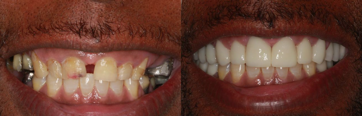 Before & After from Southern Dental Implant Center | Cordova, TN