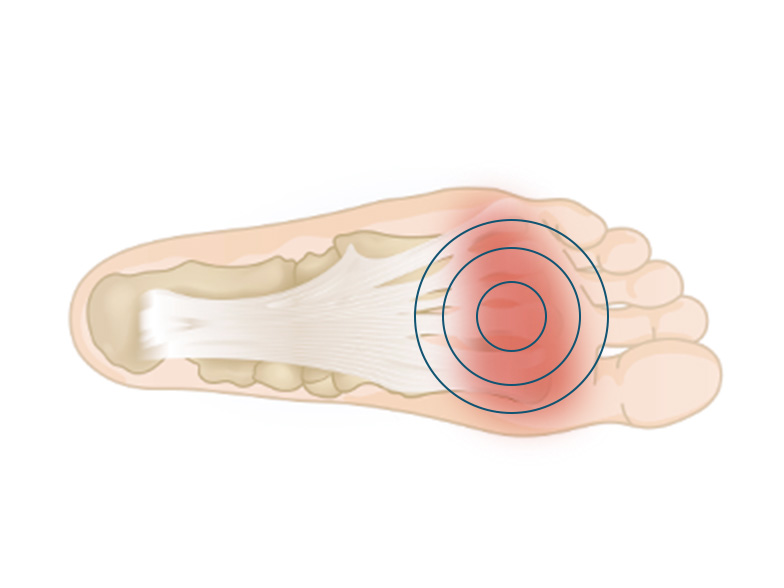 Cncrns_Cndtns-footpain-ball-392x294@2x.jpg