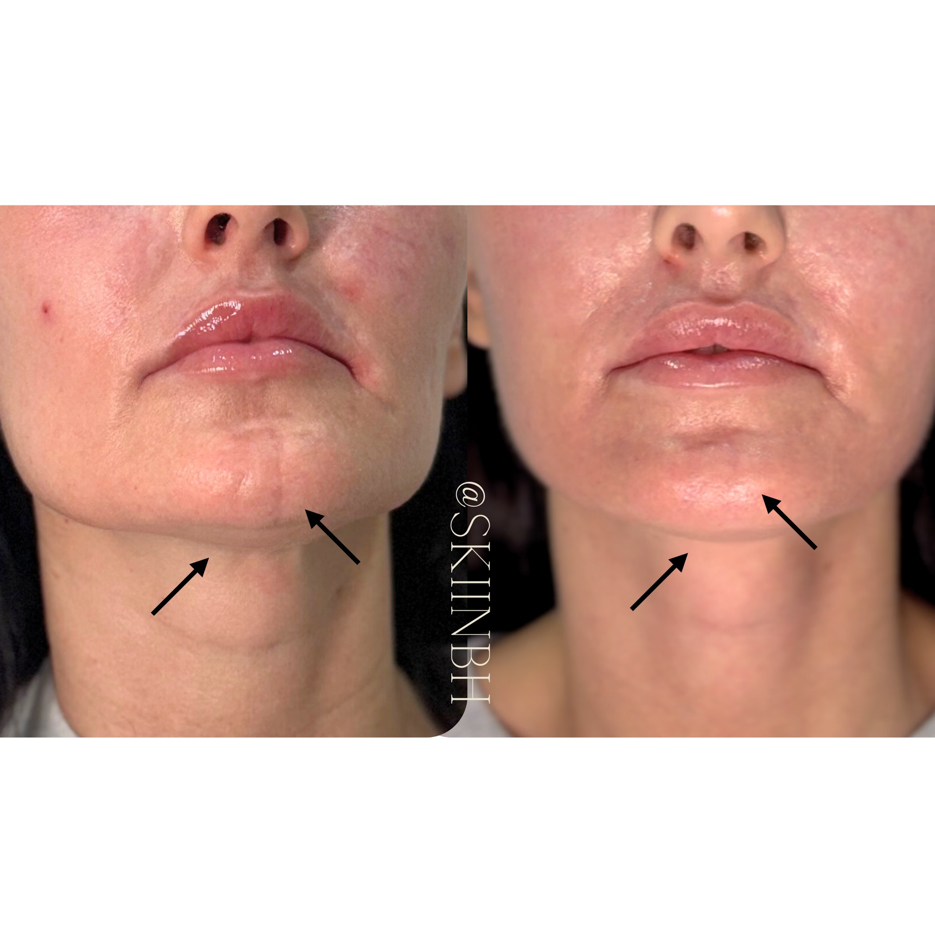 Morpheus8 results for scars and skin tightening!