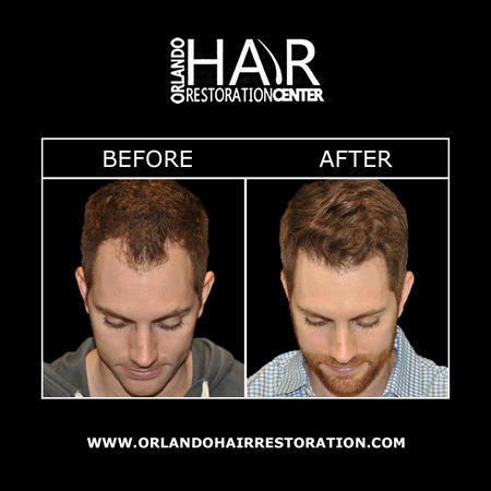 NeoGraft® hair restoration utilizes the automated Follicular Unit Extraction (FUE) technique to transplant hair follicles with the utmost precision. The specialized NeoGraft® “No Touch” method ensures that your natural hair is harvested smoothly & implanted into areas where hair has thinned. There are no stitches, incisions, or unsightly lineal scarring with minimally invasive hair restoration. Contact our Orlando hair doctors to get started with your NeoGraft® consultation today.