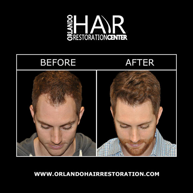 Images Orlando Hair Restoration Center