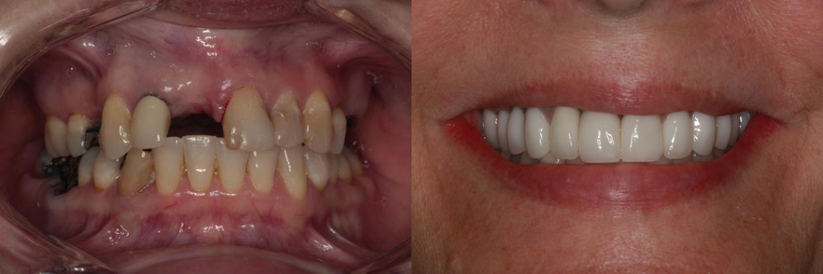Before & After from Southern Dental Implant Center | Cordova, TN, , Dentist