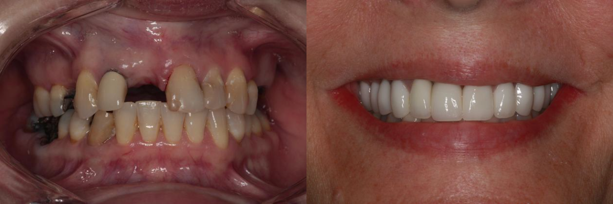 Before & After from Southern Dental Implant Center | Cordova, TN