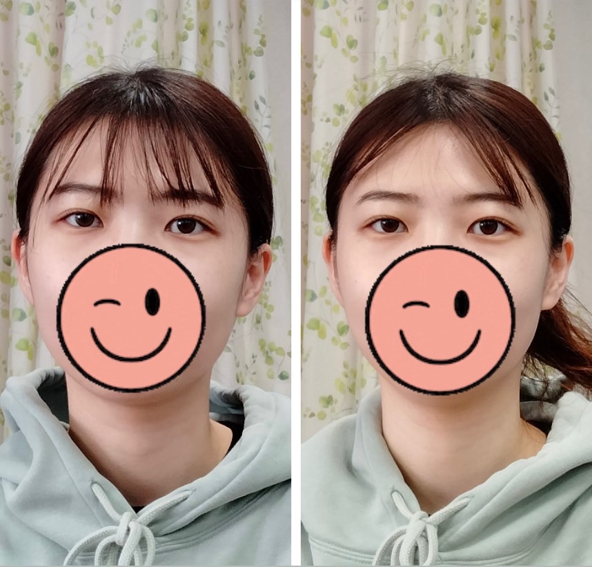 Images 目元・口元のたるみ&眉間シワ改善専門サロン