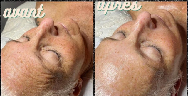 Images Onyx Esthétique - Soins esthétiques, Soins de la peau, Laser Cynosure Gatineau