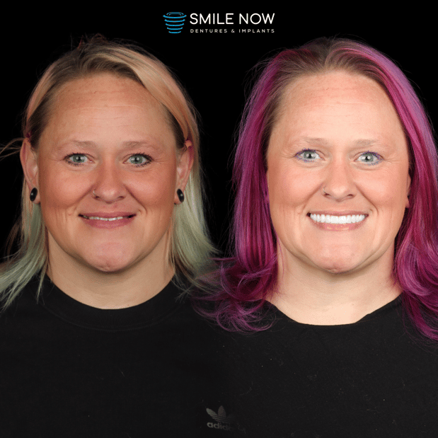Images Smile Now Milwaukee Dentures and Implants