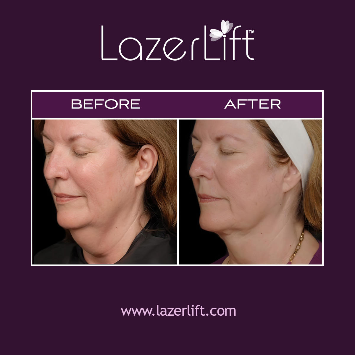 Neck lift in Orlando uses innovative LazerLift® technology to treat skin that has lost its elasticity as an effect of aging. LazerLift® heats the lower layers of the skin, melting away excess fat and promoting collagen production to smooth neck bands, tighten sagging skin, address the dreaded “turkey neck,” and restore jawline contours. LazerLift® laser neck lift is minimally invasive and requires little-to-no downtime.