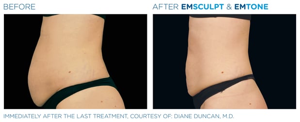 Images Columbus Emsculpt