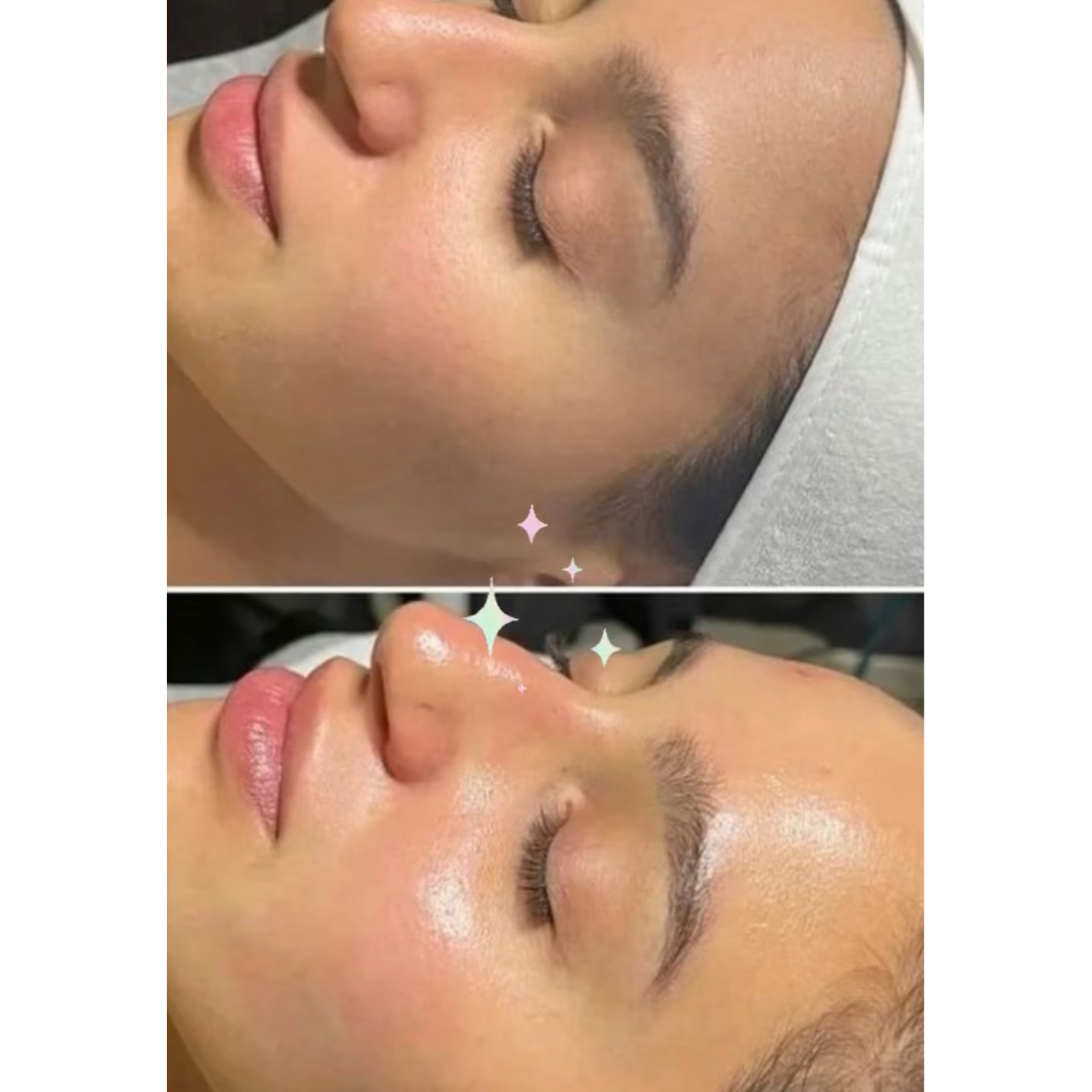 Hydrafacial treatment result at KWJ Skin Clinic, an aesthetic clinic near Horsham offering advanced facials, skin rejuvenation, Hydrafacial treatments and medical-grade skincare.