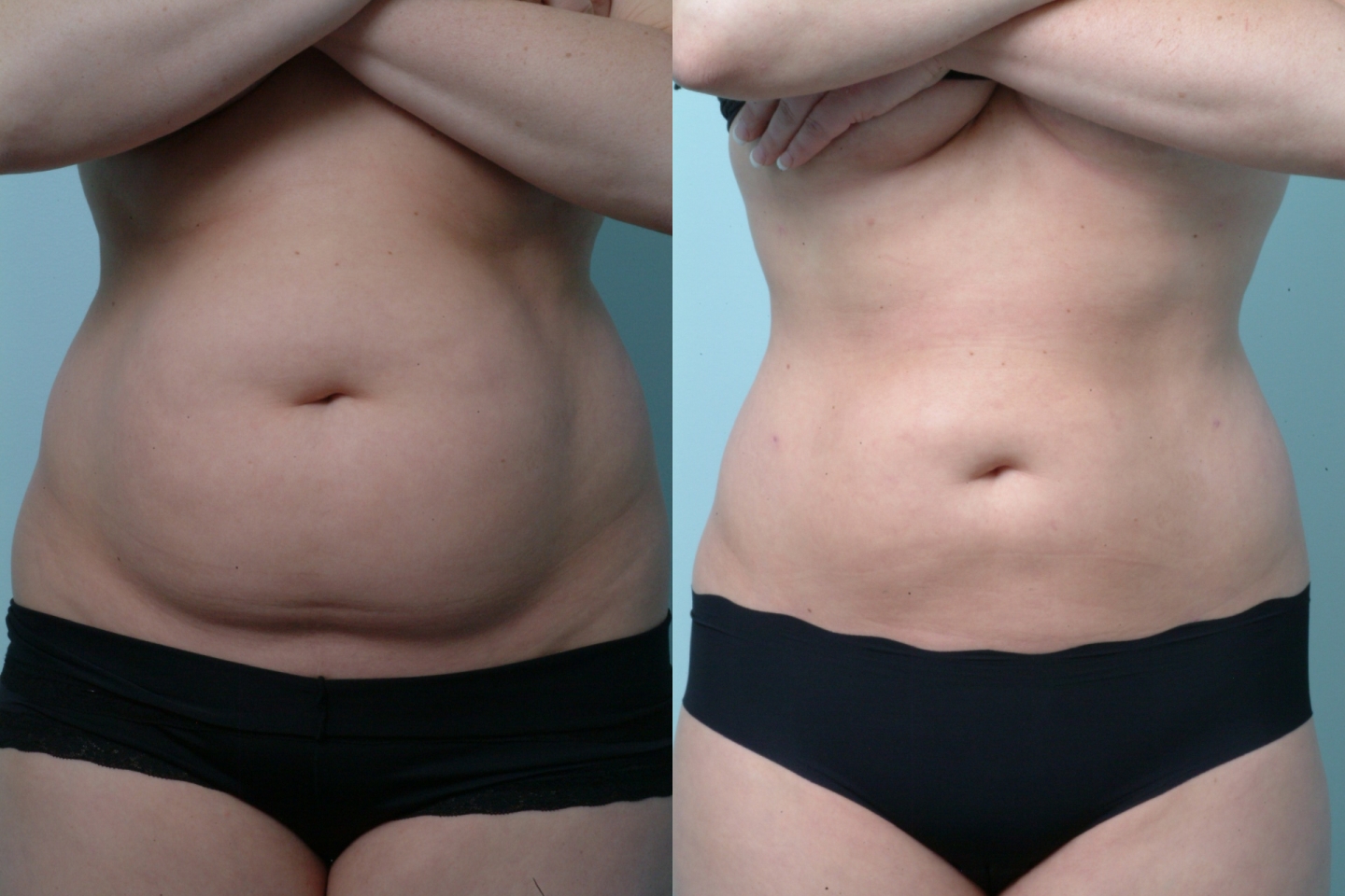 Tummy Liposuction - before and after