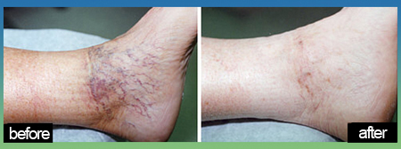 Image 7 | Laser Lipo and Vein Center