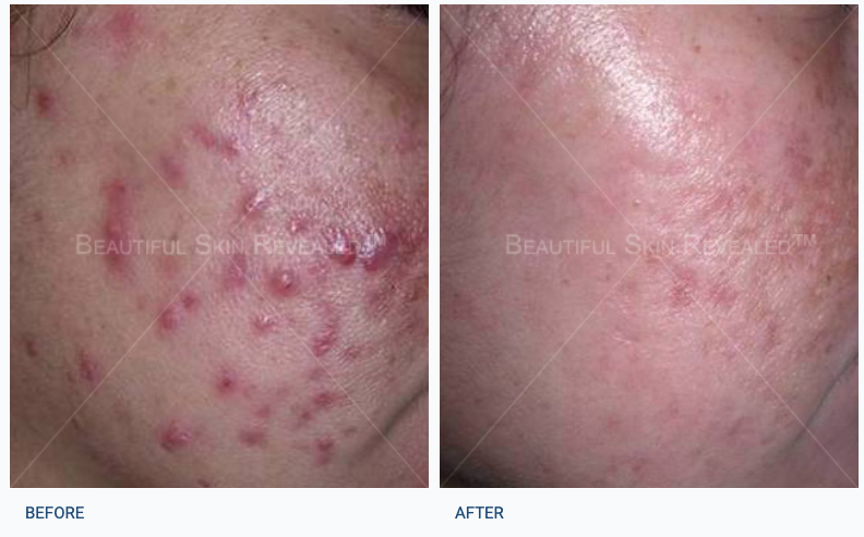 Before and After | Acne Treatment at Dermatology & Laser Surgery Center