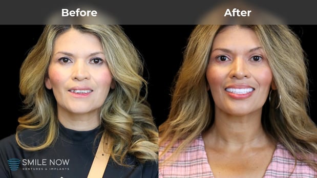 Images Smile Now Milwaukee Dentures and Implants