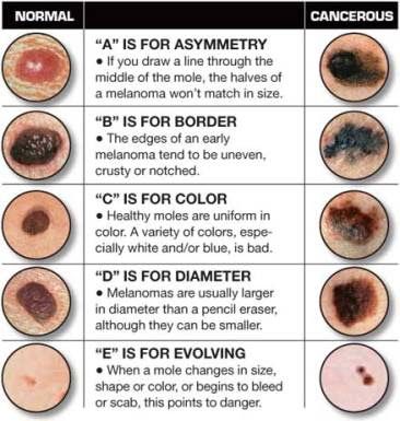 Skin cancer is the most common of all cancers, afflicting more than two million Americans each year, a number that is rising rapidly. It is also the easiest to cure if diagnosed and treated early. When allowed to progress, however, skin cancer can result in disfigurement and even death.