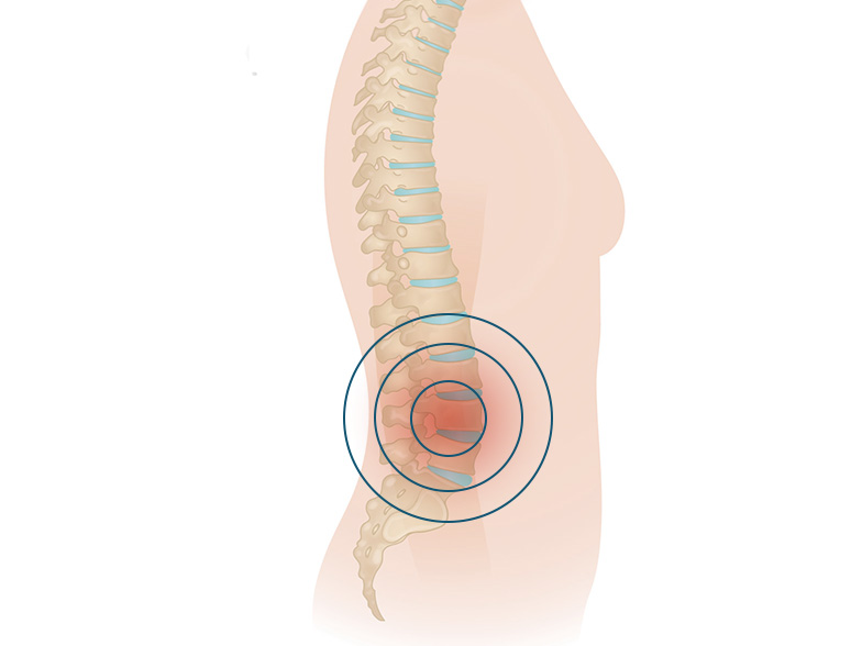 Cncrns_Cndtns-backpain-lower-392x294_@2x.jpg