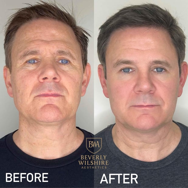 Images Beverly Wilshire Aesthetics Beverly Hills Medical Spa for Botox, Morpheus8, IPL, Lip Fillers