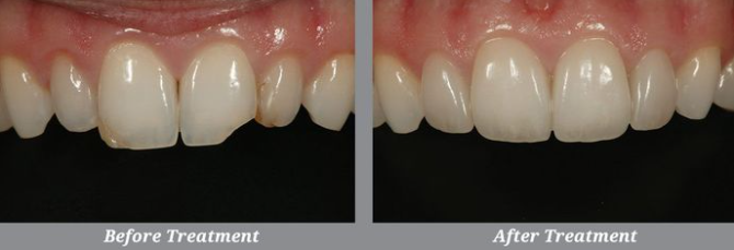 Smile Makeover Before & After, Joseph P. Fusco DDS, MAGD | Rockville Centre, NY