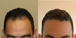Images BKS Hair Restoration