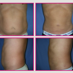 Liposuction before and after