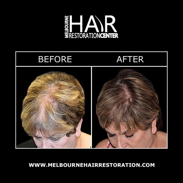 Images Melbourne Hair Restoration Center