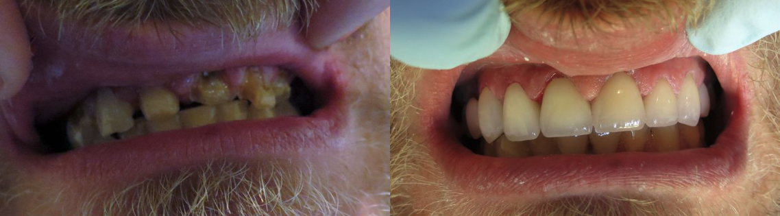 Full Mouth Rehabilitation Before & After at Lamendola Dentistry | Gonzales, LA