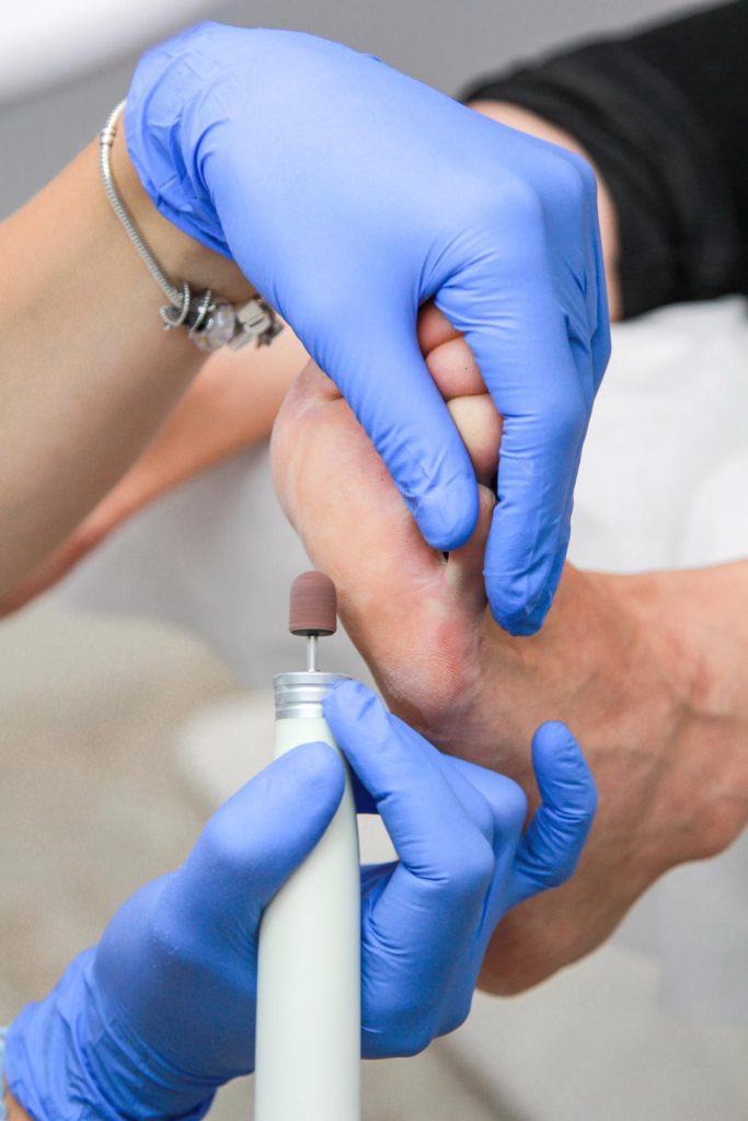 A close-up shot shows a person's foot being worked on by a podiatrist or pedicurist. The professional is wearing blue nitrile gloves and is holding a white electric nail file with a brown sanding bit. They are carefully filing the skin on the toes and sole of the foot. The foot appears to be receiving a treatment to remove calluses or dead skin. The background is blurred, suggesting a clinical or salon setting. One hand of the professional is visible on the left, adorned with a silver bracelet with charms.
