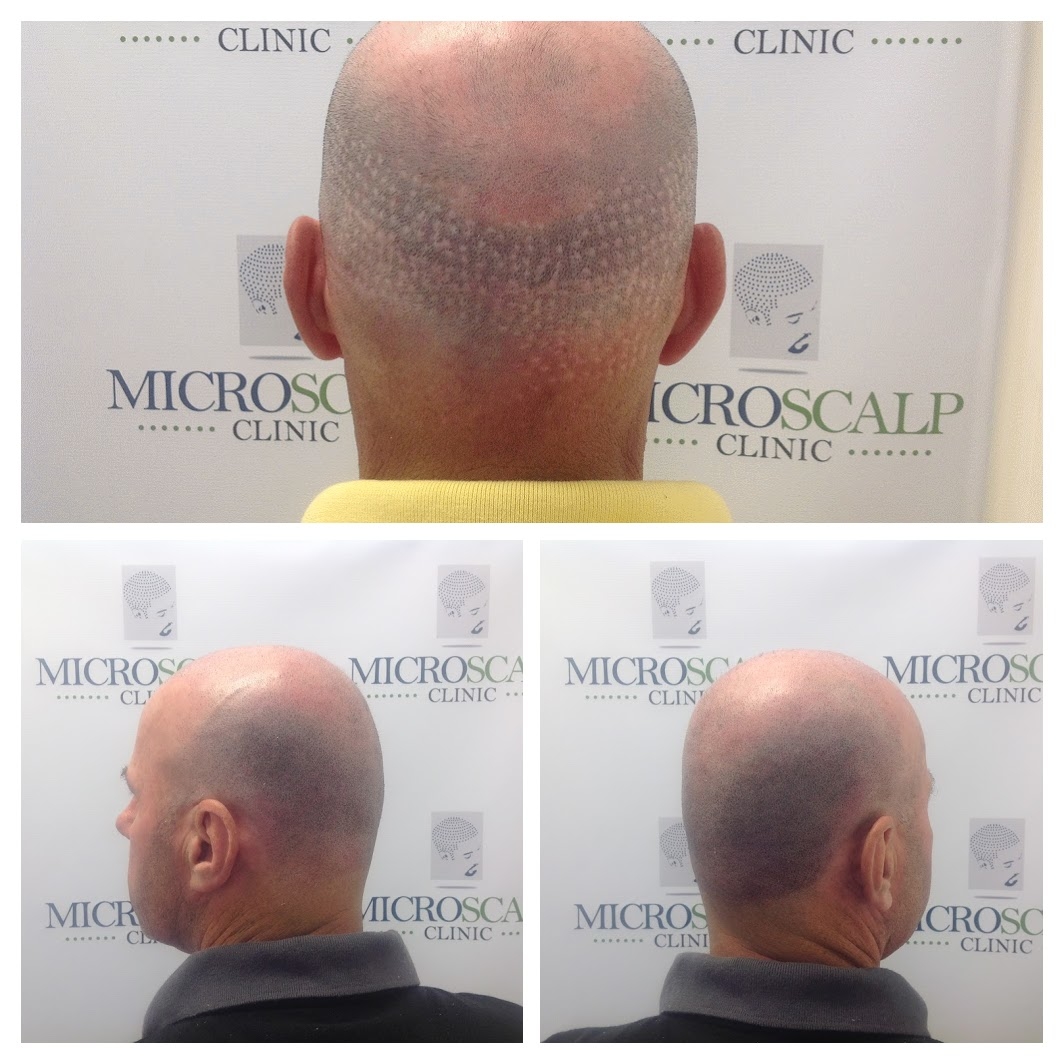 Scar treatment http://www.microscalpclinic.com/