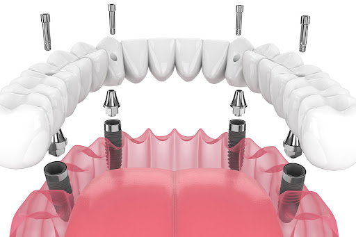 Images Advanced Dentistry & Implant Center