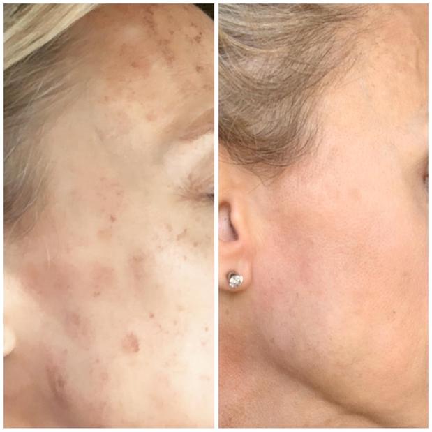 IPL before and after
IPL  treats skin pigmentation, sun damage, and thread veins
wymorelaser.com 4007-622-2252
