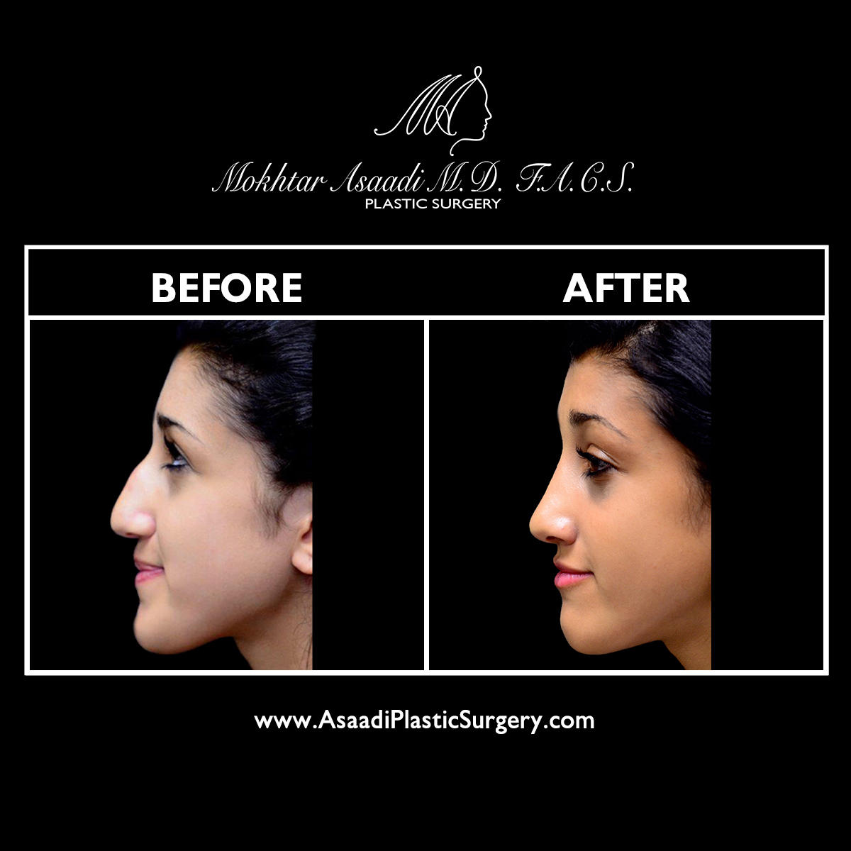 Rhinoplasty, a procedure to reshape your nose, can provide transformative results for the overall symmetry of your face. Patients seeking rhinoplasty in NJ turn to Asaadi Plastic Surgery for the most natural-looking results. Rhinoplasty can correct the tip or bridge of your nose by narrowing the nostrils or changing the angle of your nose and your upper lip. The rhinoplasty procedure can also correct a deviated septum.