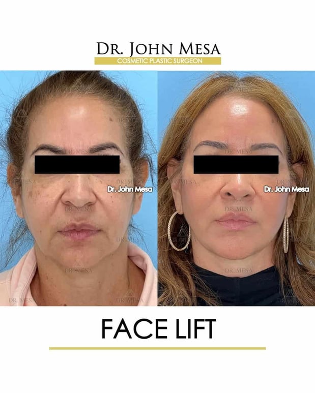Images Dr. John Mesa, MD: Plastic Surgeon NYC, Buccal Fat Removal, Chin Liposuction, Facelift, Facial Masculinization, Chin Implant