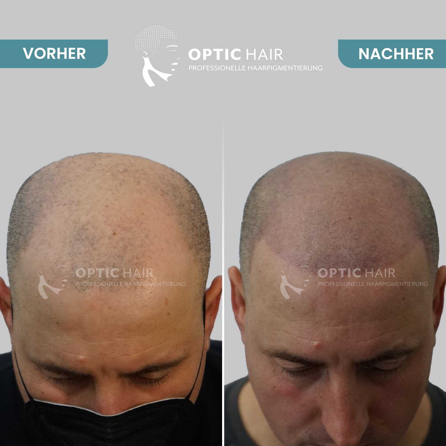 Kundenfoto 11 Haarpigmentierung Köln | OpticHair