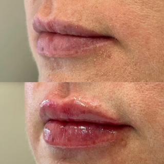 Lip Filler Before and After 1 syringe of Restylane Kysse