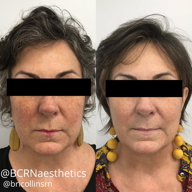 Images BCRN Aesthetics MedSpa
