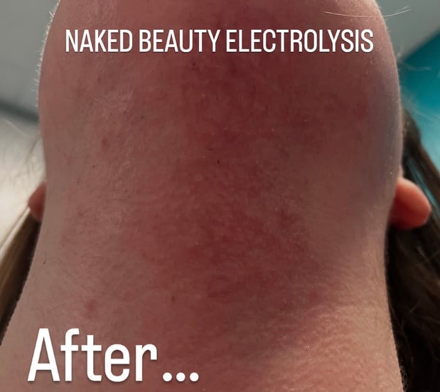 Images Naked Beauty Electrolysis