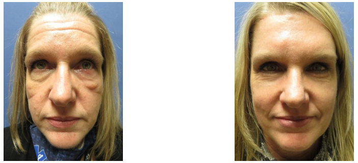 Before & After Results at Devlin Cosmetic Surgery: Michael Devlin, M.D. | Little Rock, AR