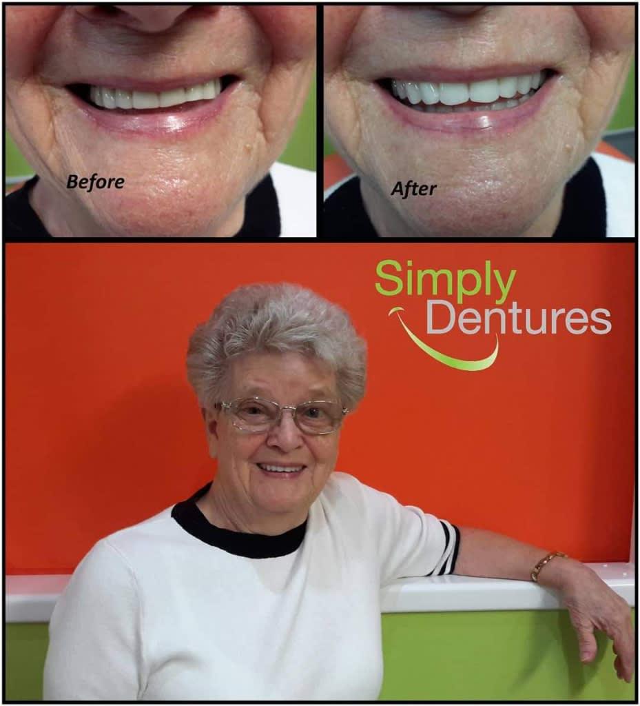 Images Simply Dentures