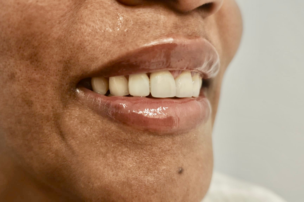 Images Dra. Silvia Solà. Medicina Estética y Láser