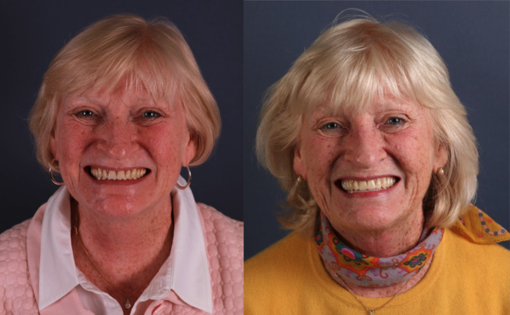 Before & After at Schmitt Prosthodontics | Altamonte Springs, FL