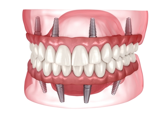 Images Best Value Dentures and Implants Palmetto Bay