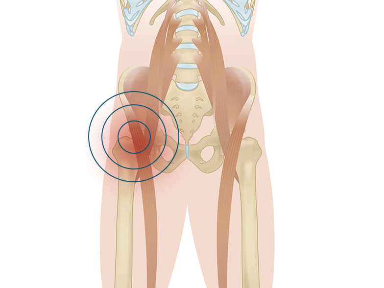 Cncrns_Cndtns-hippain-side-392x294@2x.jpg